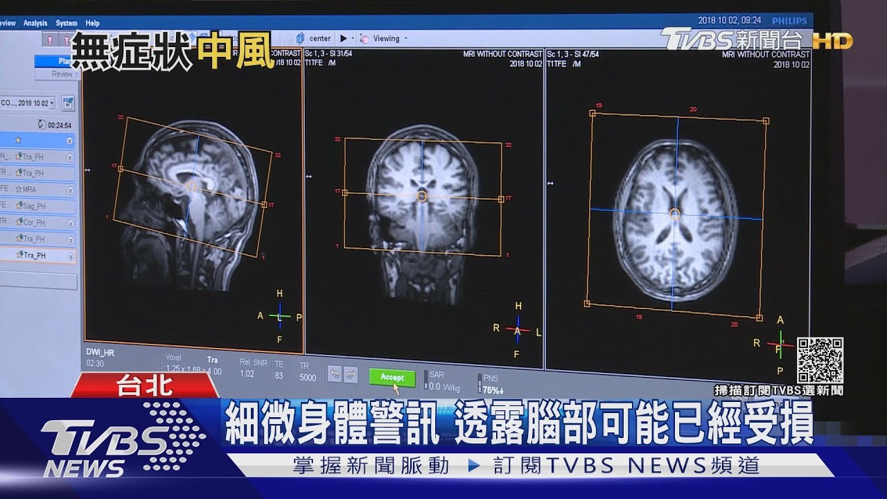 有片／明明無徵兆卻中風了？醫師：「這幾類人」是高危險族群