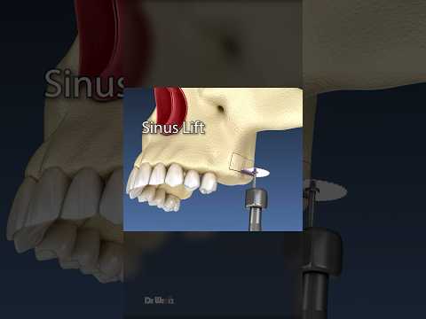 Sinuslift-Operation: 3D-Animation