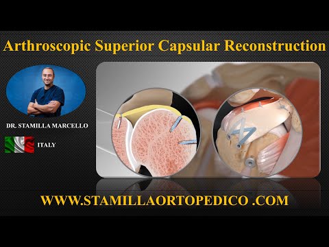 SCR MARTRIX SPALLA 3D LIVE BY DR. STAMILLA