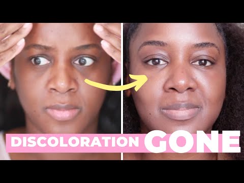 How I Got Rid of My Dark Circles (Black Skin)