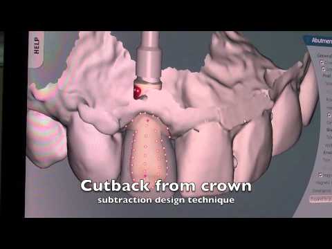 ASC Abutment - How it works? Dental Implant