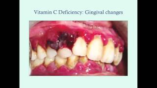 Vitamin C - CRASH! Medical Review Series