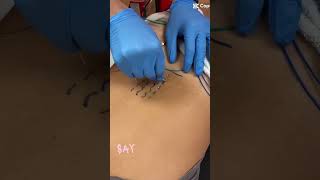 #weekend Jackson MS #dryneedling