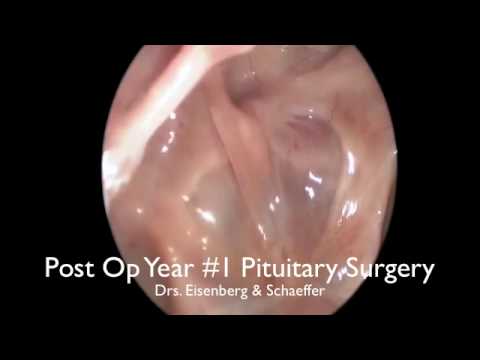 Follow up after Endoscopic Pituitary Surgery