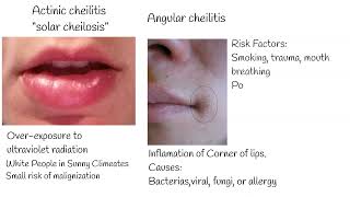 Dry Lips, cheilitis , Chapped Lips, Herpes on lips