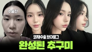 화려한 직반라인으로 완성된 추구미 #코재수술
