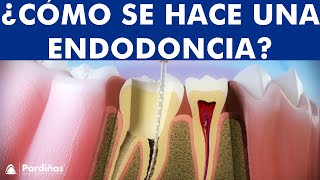 Endodoncia - Tratamiento para la caries profunda © - Clínica Dental Pardiñas