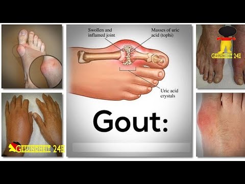 Verursacht Schmerzen in den Muskeln des Rückens Erkrankung der Gelenke und Hände