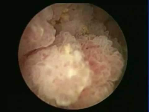 comment soigner tumeur maligne