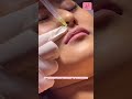 Improved Lip Shape By Fillers Live Procedure Shorts Shortsfeed Lipfiller