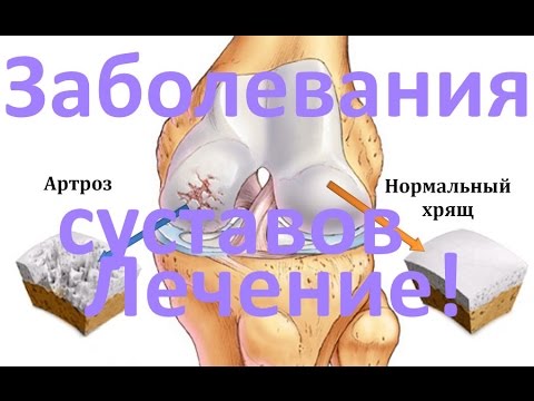 Какие признаки шейного и грудного остеохондроза Алоэ от болей в суставах