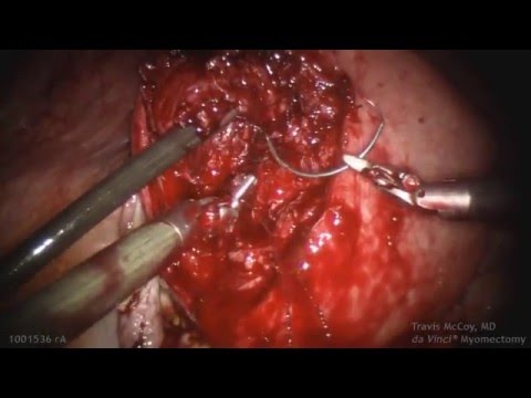 da Vinci Myomectomy- Excision of Large Necrotic Fibroids