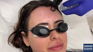 Download the video "Erbium Laser Resurfacing Treatment"