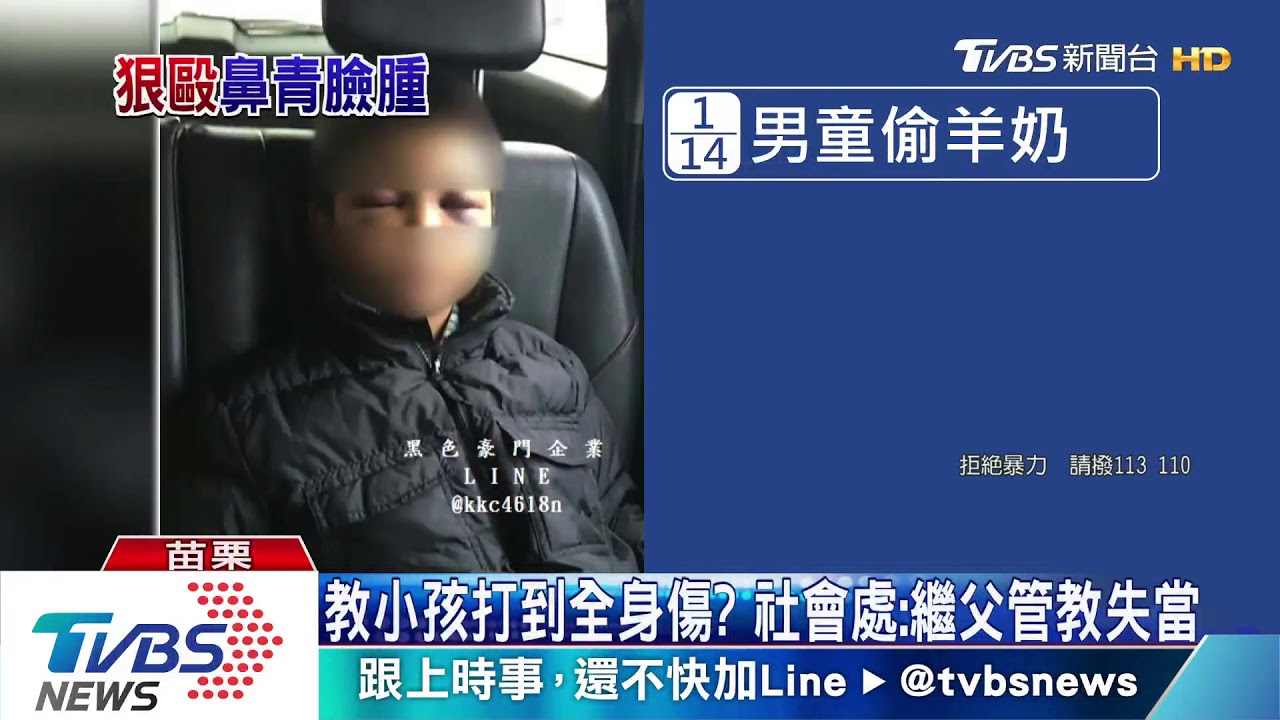 9歲男童全身傷!繼父:他偷竊 為管教而打