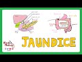 jaundice differential diagnosis of jaundice prehepatic hepatic post hepatic causes of jaundice