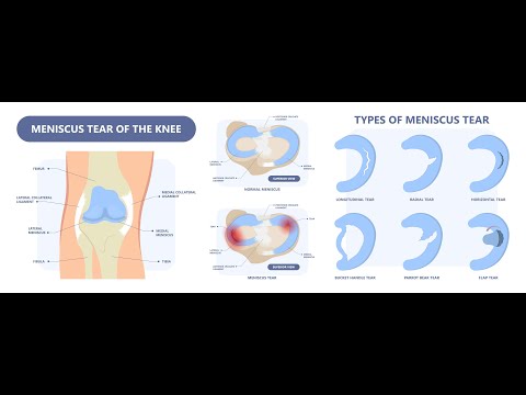 Video thumbnail: Meniscal tears & perimeniscal cyst animation