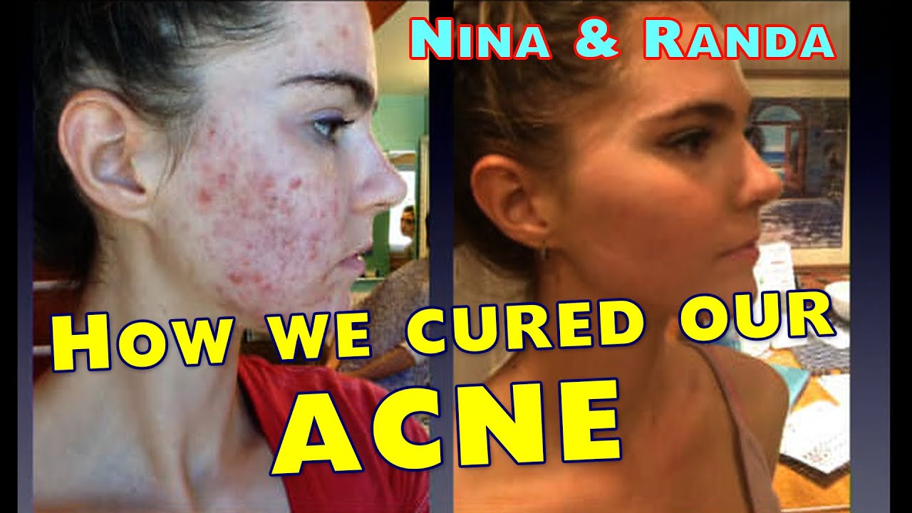 How We Cured Our Acne – Our First Acne Video That Went Viral (6:38)