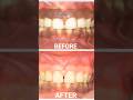 Depigmentation Of Gums Black Gums To Pink Gums ️ Dr Pratibha Shorts Dental Viral Trending