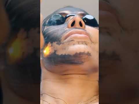 Hollywood Peel Sincelejo - Centro de cirugía plástica y estética Dr. Roger Ruiz