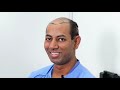 Best Hair Transplant in India 2020 FUT FUE BHT in Higher Grade Baldness