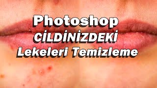 YÜZDEKİ LEKELERİ TEMİZLEME. (PHOTOSHOP D. 30)