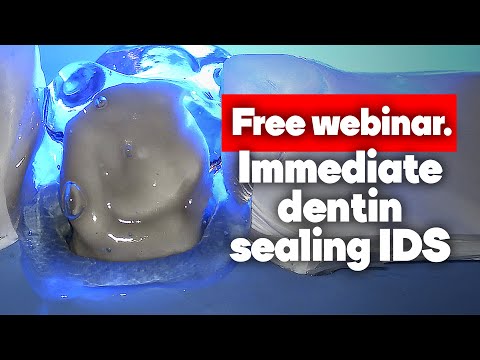 Immediate Dentin Sealing (IDS)