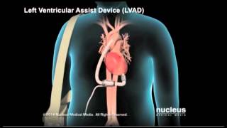 Left Ventricle Assist Device
