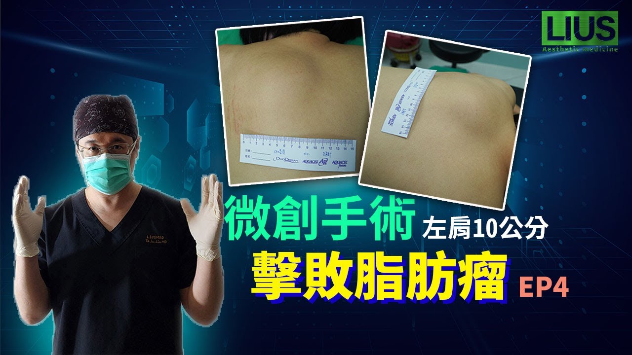10公分深層肌肉下脂肪瘤僅需4公分切口