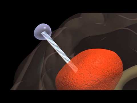 Ученые научились выводить раковые клетки из мозга по «монорельсу». Ученые научились выводить раковые клетки из мозга по «монорельсу». Фото.