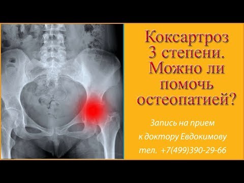 Протрузия межпозвонковых дисков и грыж Боли в спине с левой стороны у мужчин
