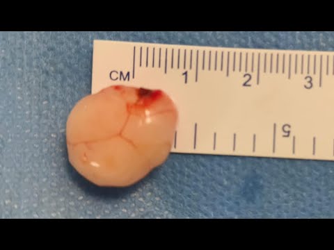 Spinal cord tumour surgery - Dr. Ajay Kothari