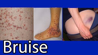 Bruise,  Hematoma, blue spots on skin.  causes and treatment