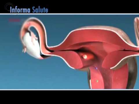 Informasalute 21/10/2015 - Come affrontare la menopausa