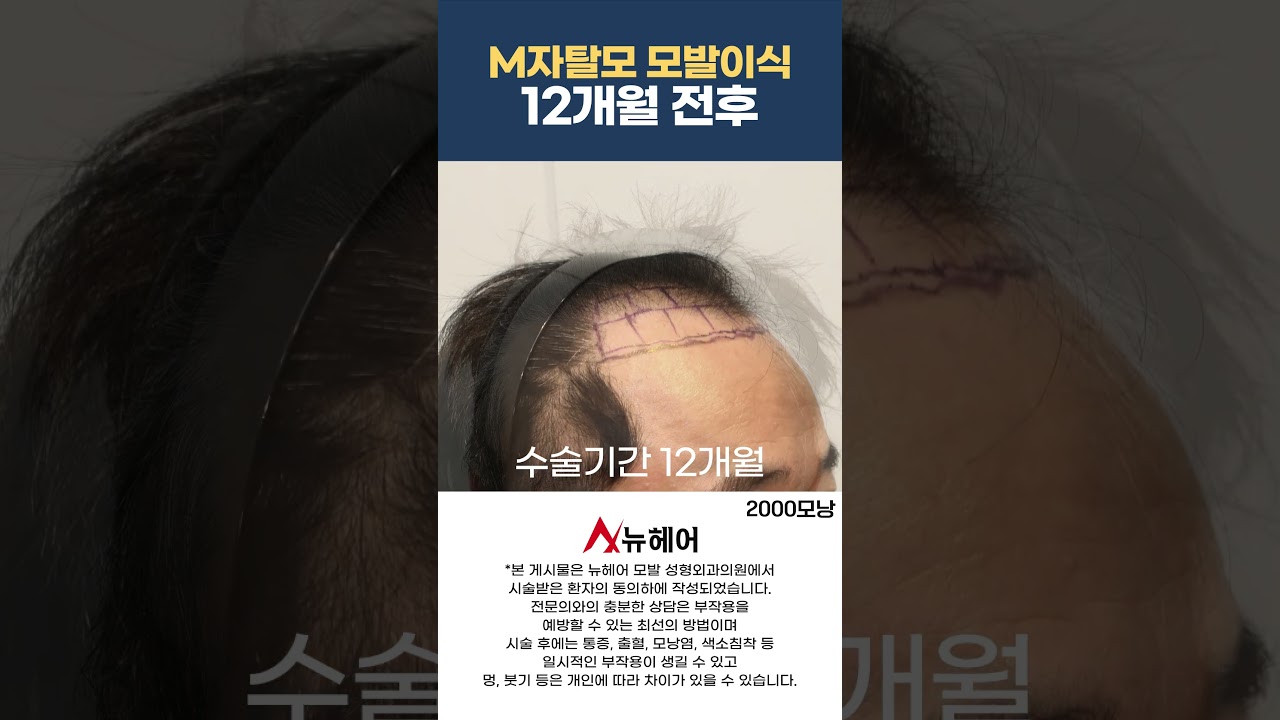 m字型脱发完全消失的毛发移植后期 ㅣ2000毛囊 ㅣ New Hair