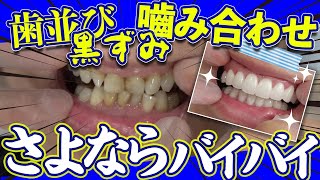 【セラミック矯正】劇的3症例！歯並び・黒ずみコンプレックス解消！サムネイル