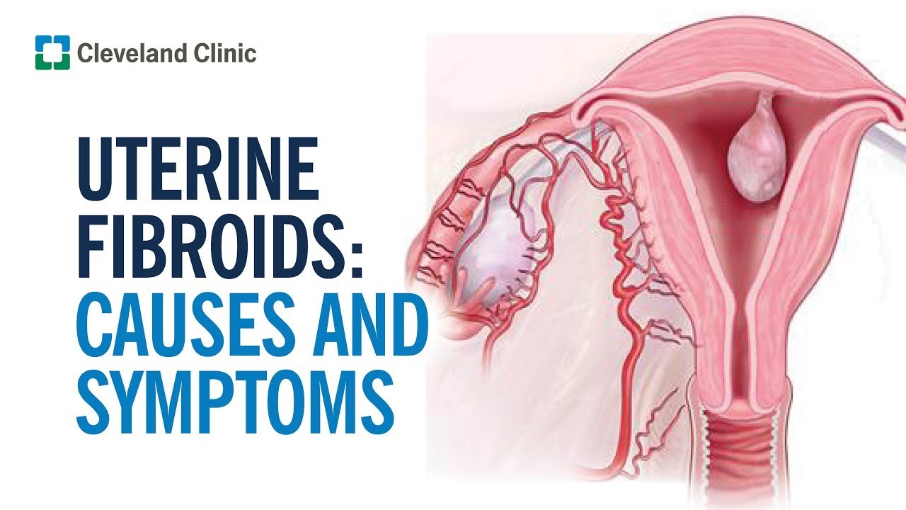 What Are Fibroids?