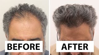 Saudi Arabia Patient FUT Hair Transplant Before and After Results