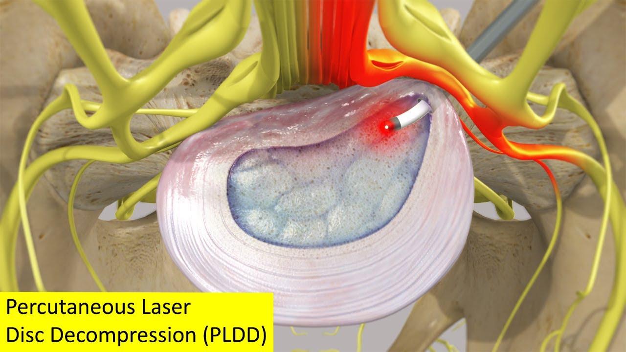 Percutaneous laser disc decompression (PLDD) (old version)