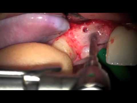 Dental Implant Placement 11 following autogenous bone graft