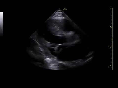 Bedside transthoracic echocardiogram demonstrating a flail posterior mitral leaflet.