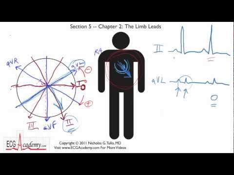 Interpretacja EKG - Odprowadzenia Kończynowe Lub Czołowe, 5-2