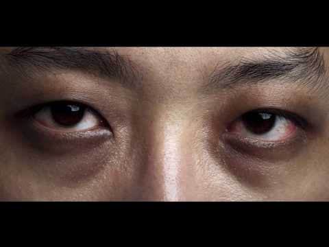 Treatment for Dark Circles| DRR Eye Care and Oculoplasty Hospital