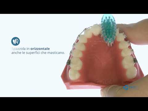 Tutorial Igiene Orale con Apparecchio Ortodontico