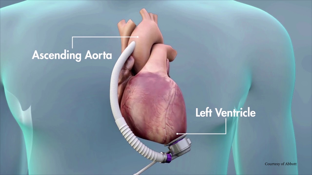 Heart Mate 3 LVAD