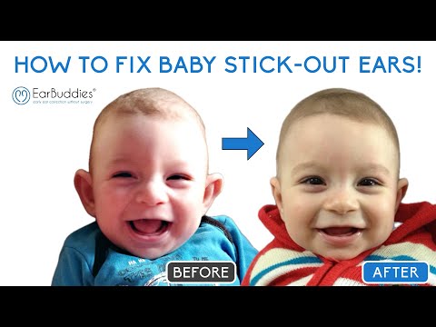 EarBuddies - Fix your Baby's Stick-Out Ears at Home!