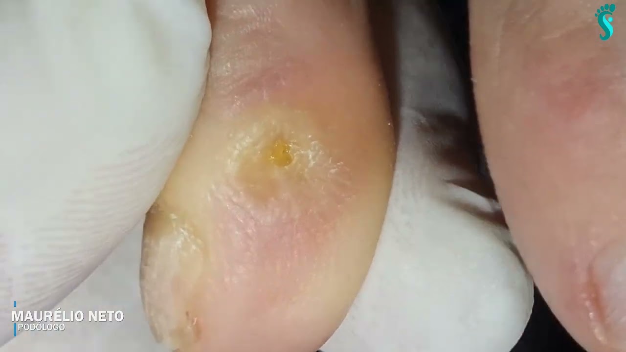 VOCÊ JÁ TEVE OU TEM UM CALINHO ENTRE OS DEDOS   #calos  #podologomaurelio #podologiaporamor