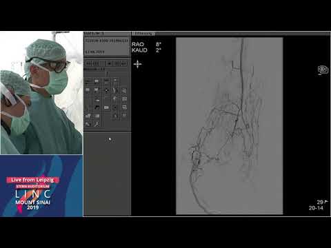 Stern D2 - Live Case - Calcified BTK CTOs Left, CLI - Leipzig, Germany