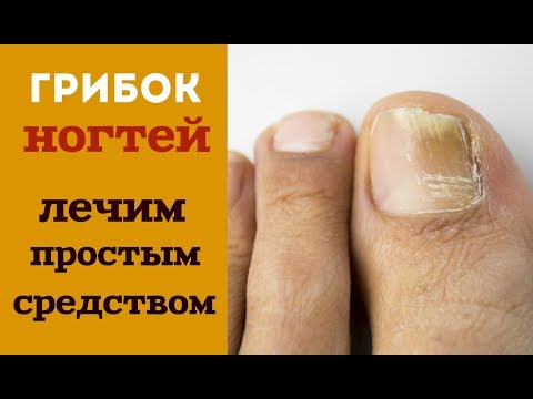 Als die Hautentzündung mit gribkom zu behandeln Die Nagelmykose die Onychomykose die Behandlung