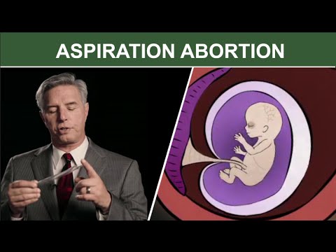 第一期妊娠中絶手術。吸引（吸引）D＆C (1st Trimester Surgical Abortion: Aspiration (Suction) D & C)