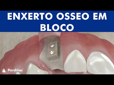 Enxerto osseo em bloco ©
